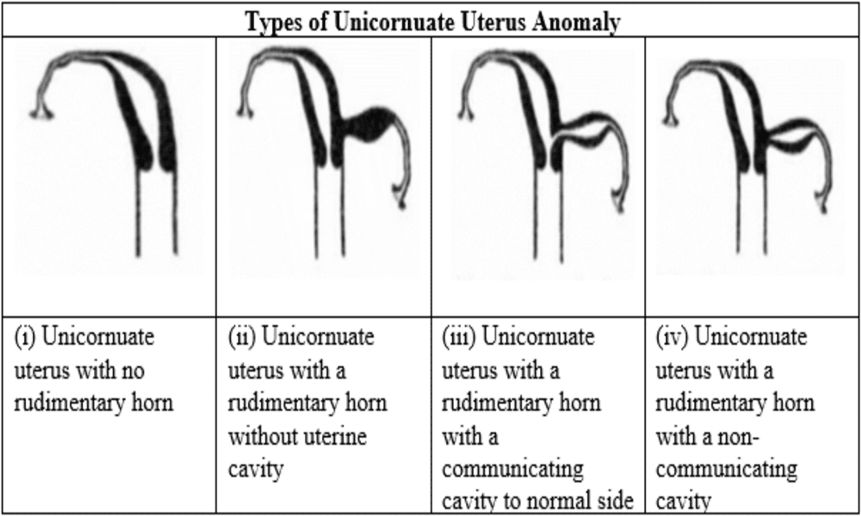 Cureus | A Unique Case of Unicornuate Uterus With a Non-communicating ...