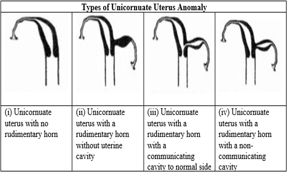 Cureus | A Unique Case of Unicornuate Uterus With a Non-communicating ...