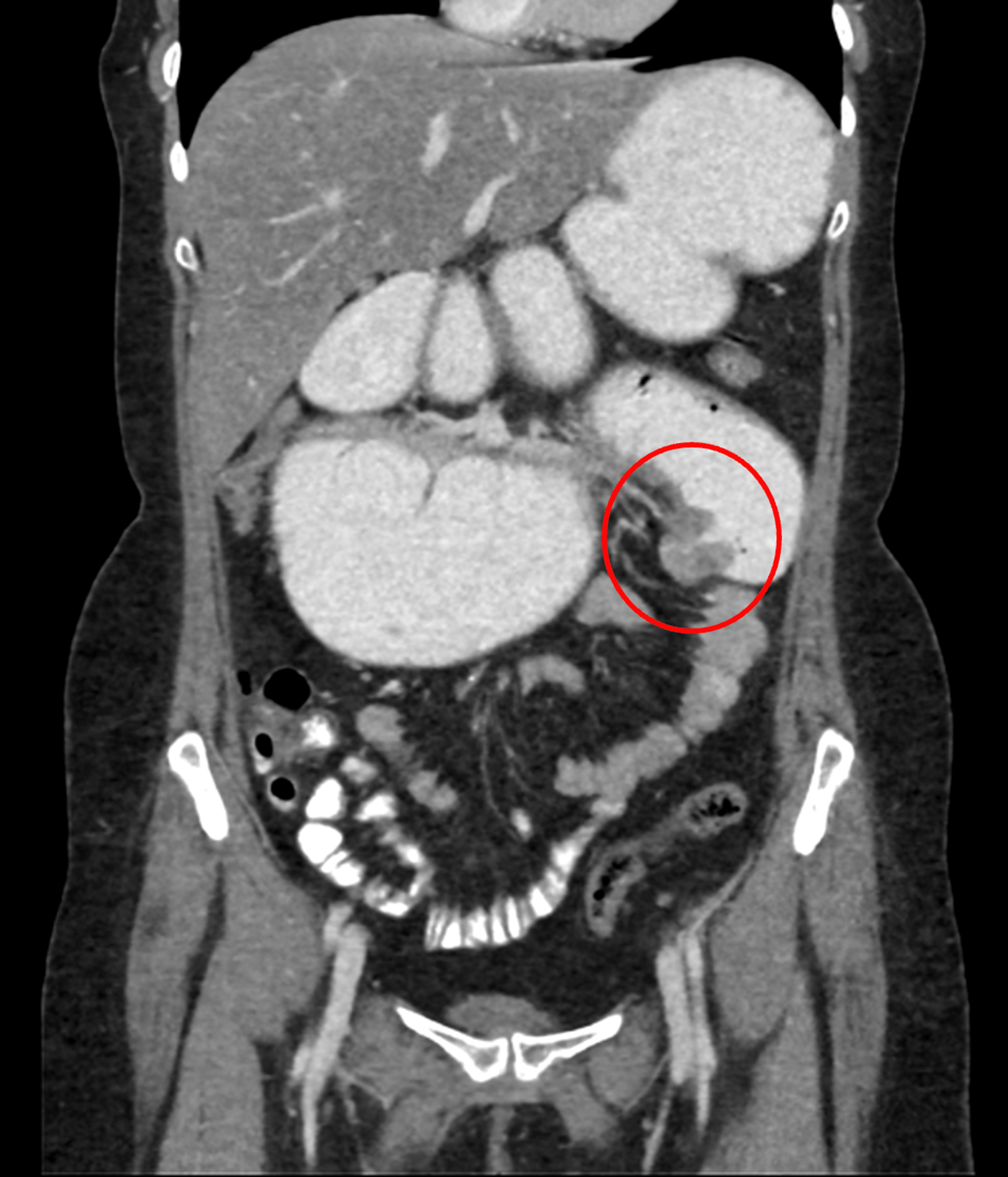 Primary Adenocarcinoma of the Jejunum Case Report of Rare Small Bowel Neoplasm Cureus