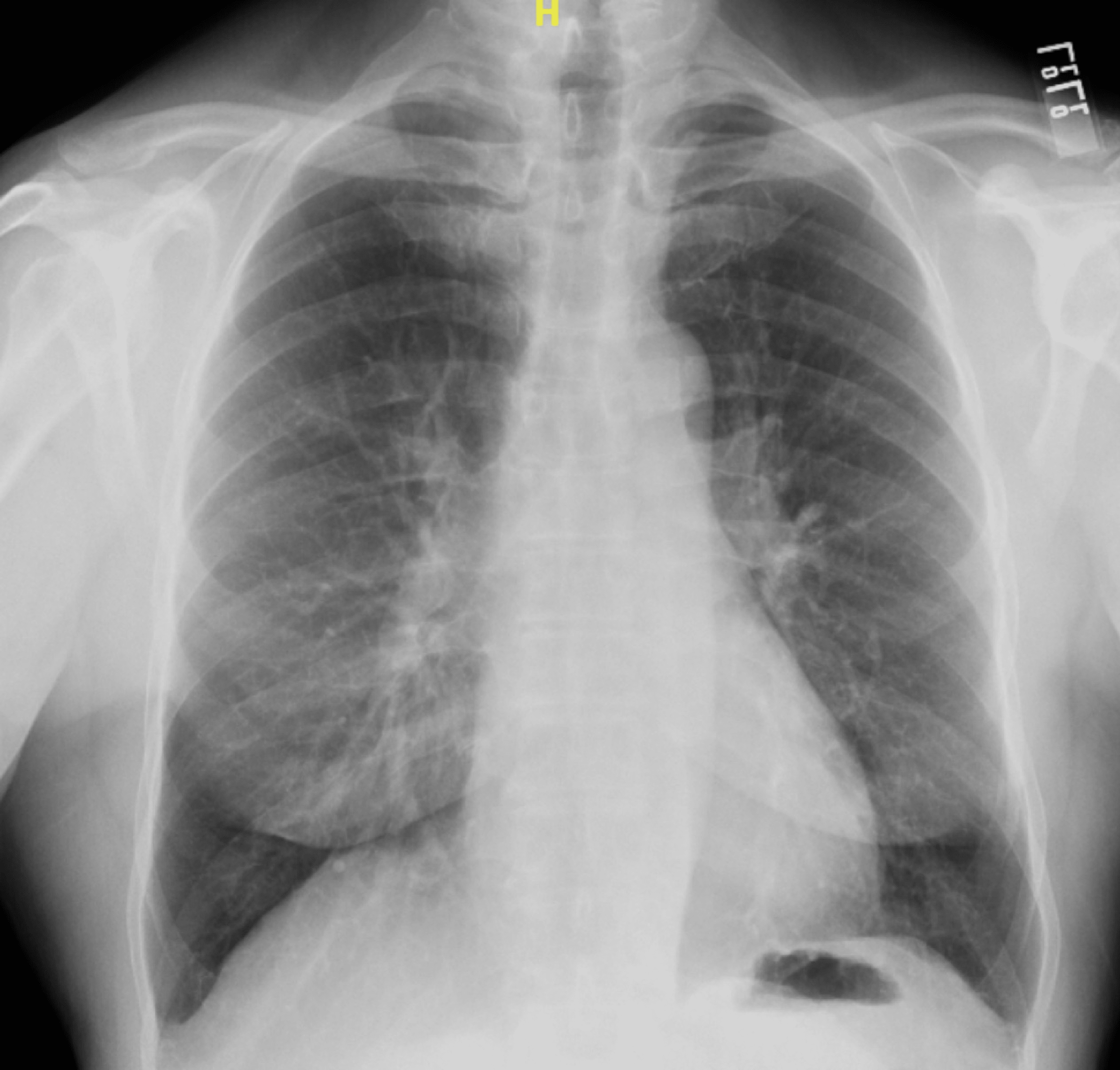 Cureus | Quinine Water-Triggered Atrial Tachyarrhythmia