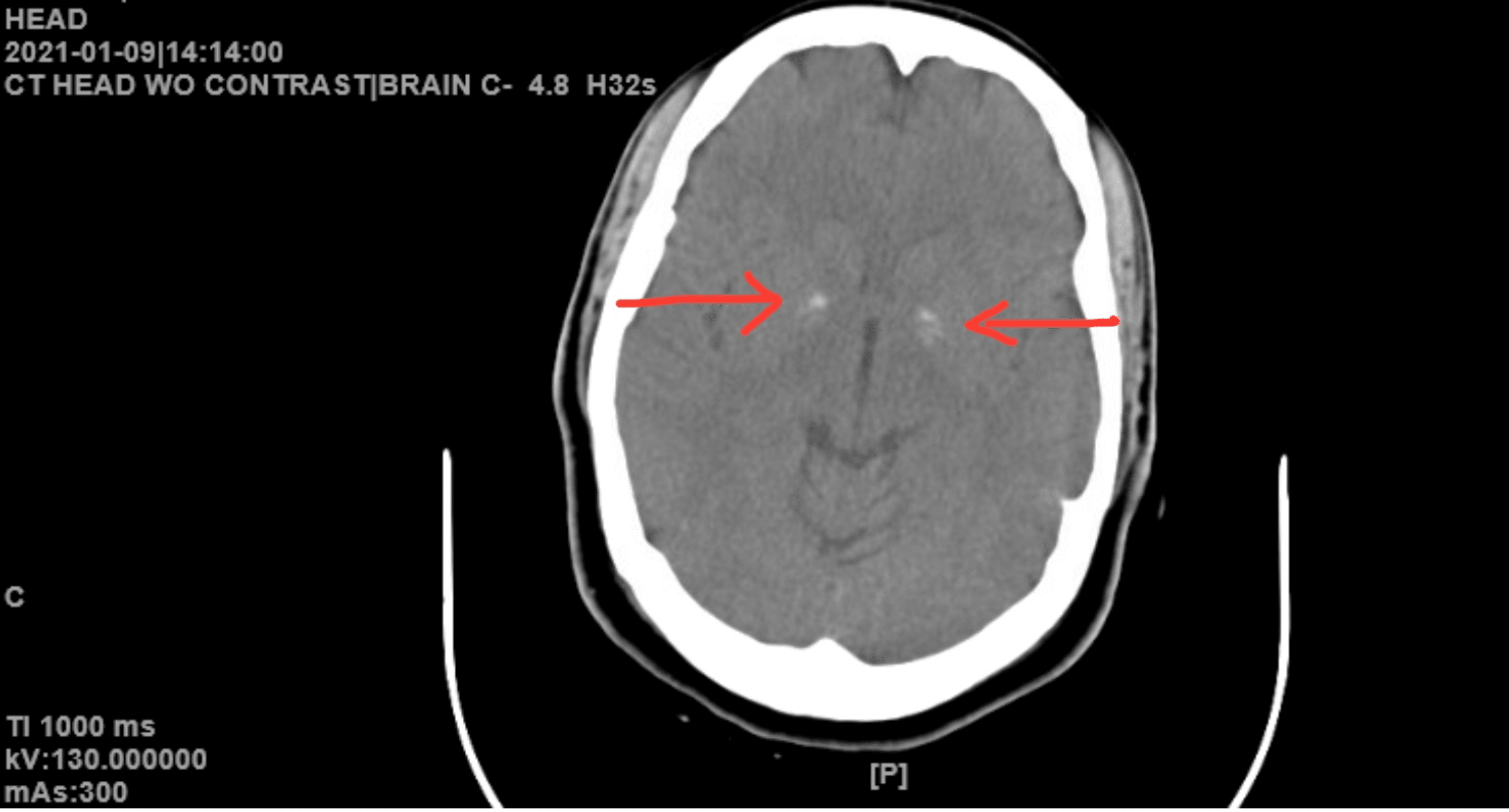 Bilateral Basal Ganglia Calcifications Manifesting as Psychosis With