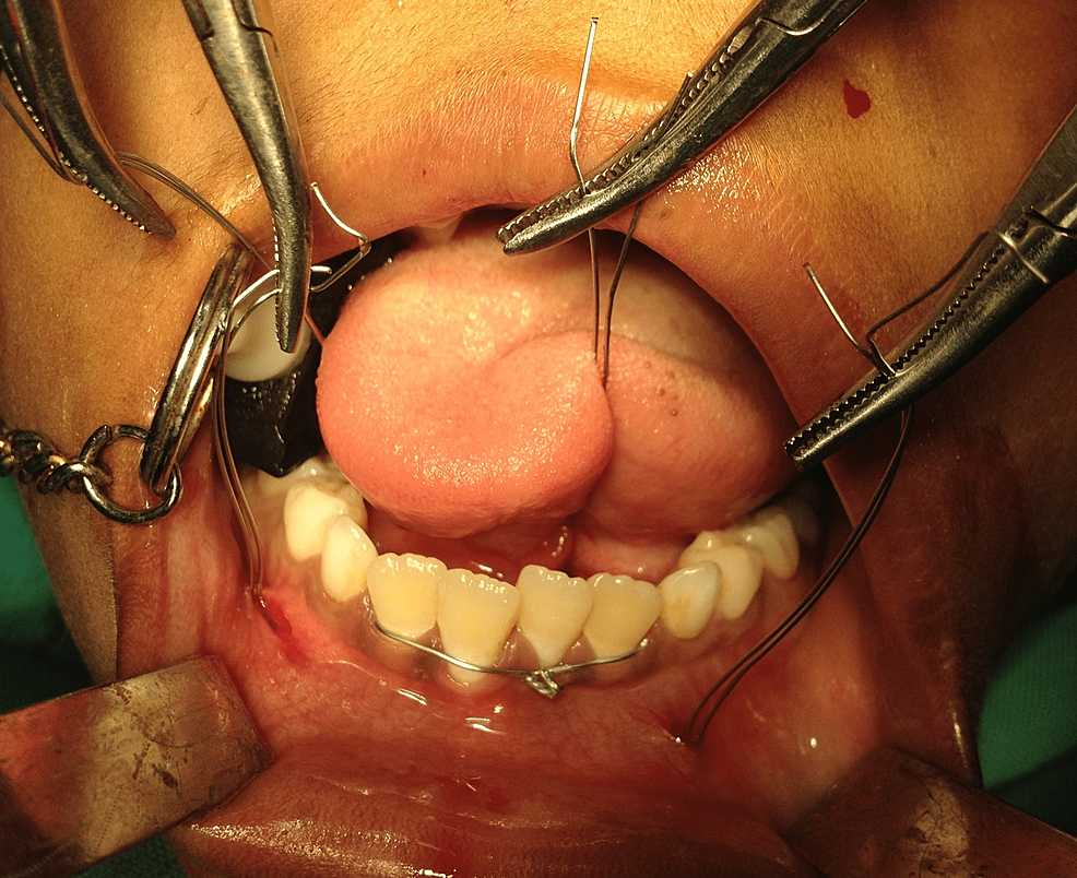 Circum-mandibular-wiring