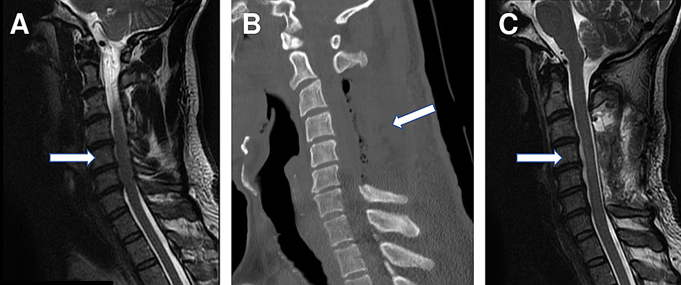 Cureus Dynamic Cervical Cord Compression Post Laminectomy Visualized By Flexion Extension 3005