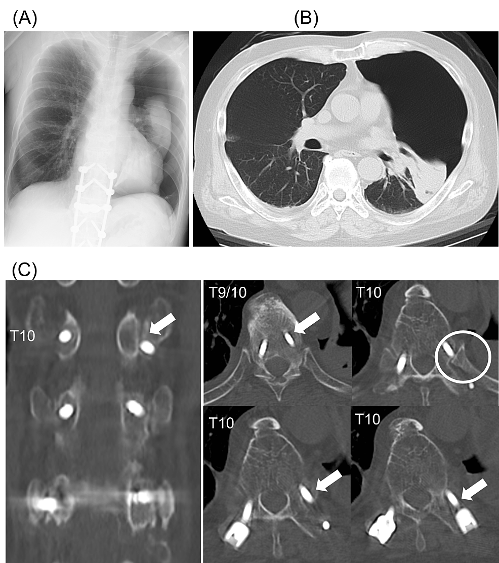 Pneumothorax By Penetrating Endplate Screw For Diffuse Idiopathic ...