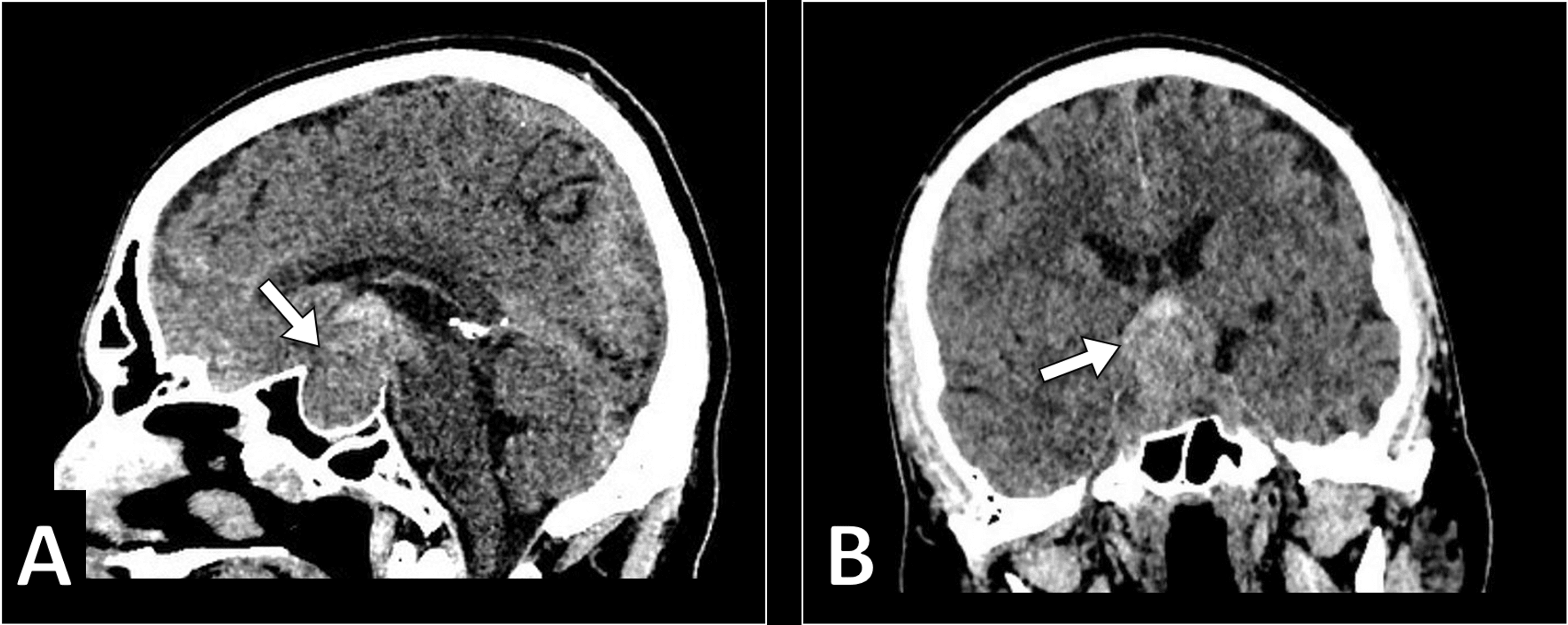 Cureus | Pituitary Apoplexy With Pituitary Macroadenoma in a Patient ...