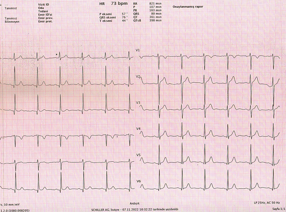 Cureus Relationship Between Atrial Fibrillation Recurrence And Frontal Qrs T Angle After 