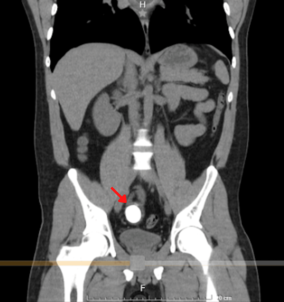 Abdominal coronal tomography - gallstones - (red arrows) - reveals the distal ileum.