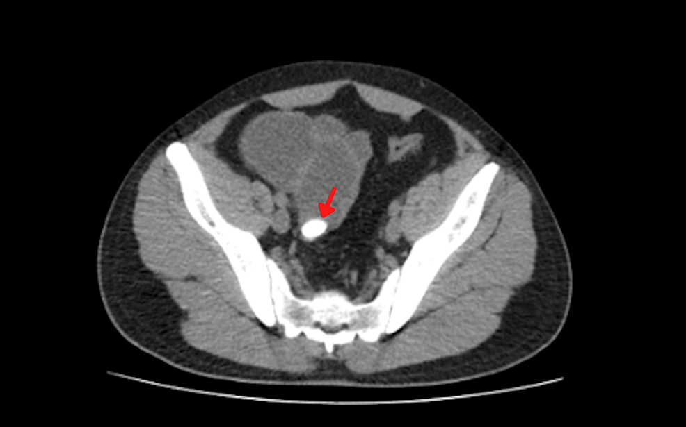 Axial-view-of-abdominal-computed-tomography-showing-the-gallstone-in-the-distal-ileum-(red arrow).