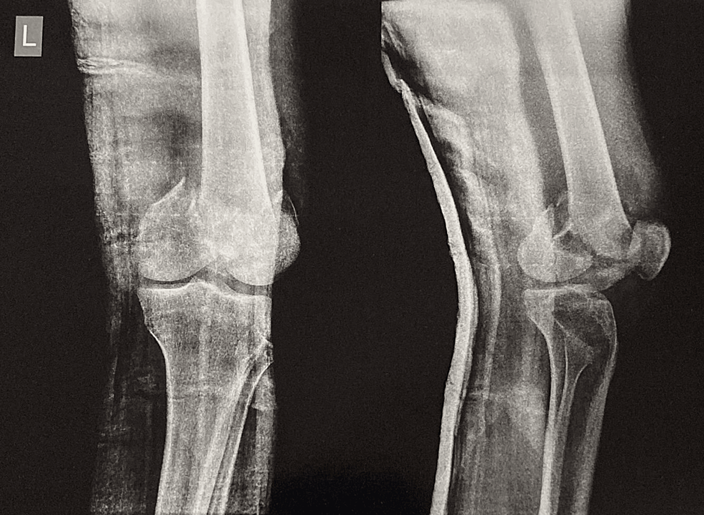 JPM | Free Full-Text | Surgical Strategy to Decrease the Revision Rate of  Fassier–Duval Nailing in the Lower Limbs of Osteogenesis Imperfecta