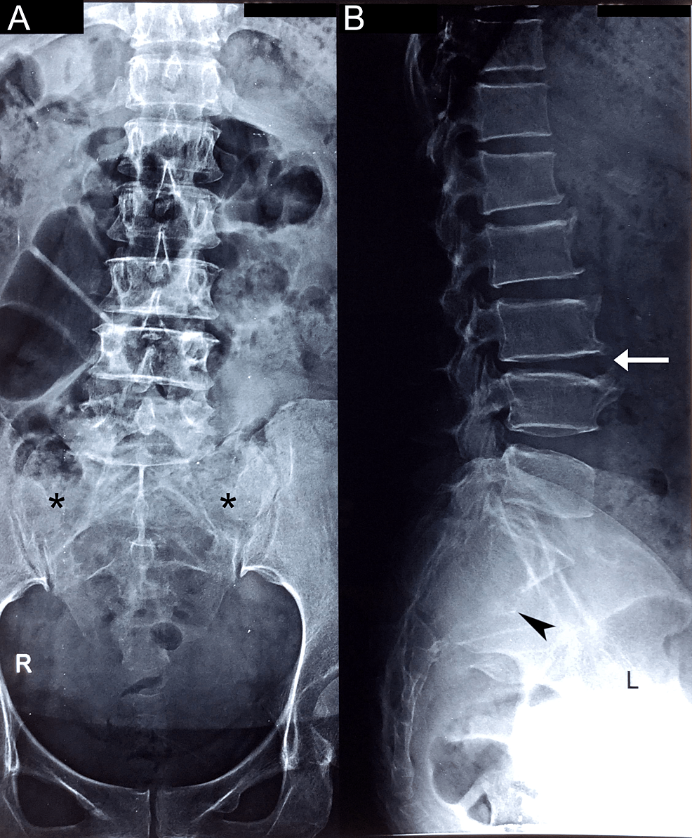 Sacral Giant Cell Tumor Presenting as Low Back Pain in the Chiropractic Office: A Case Report