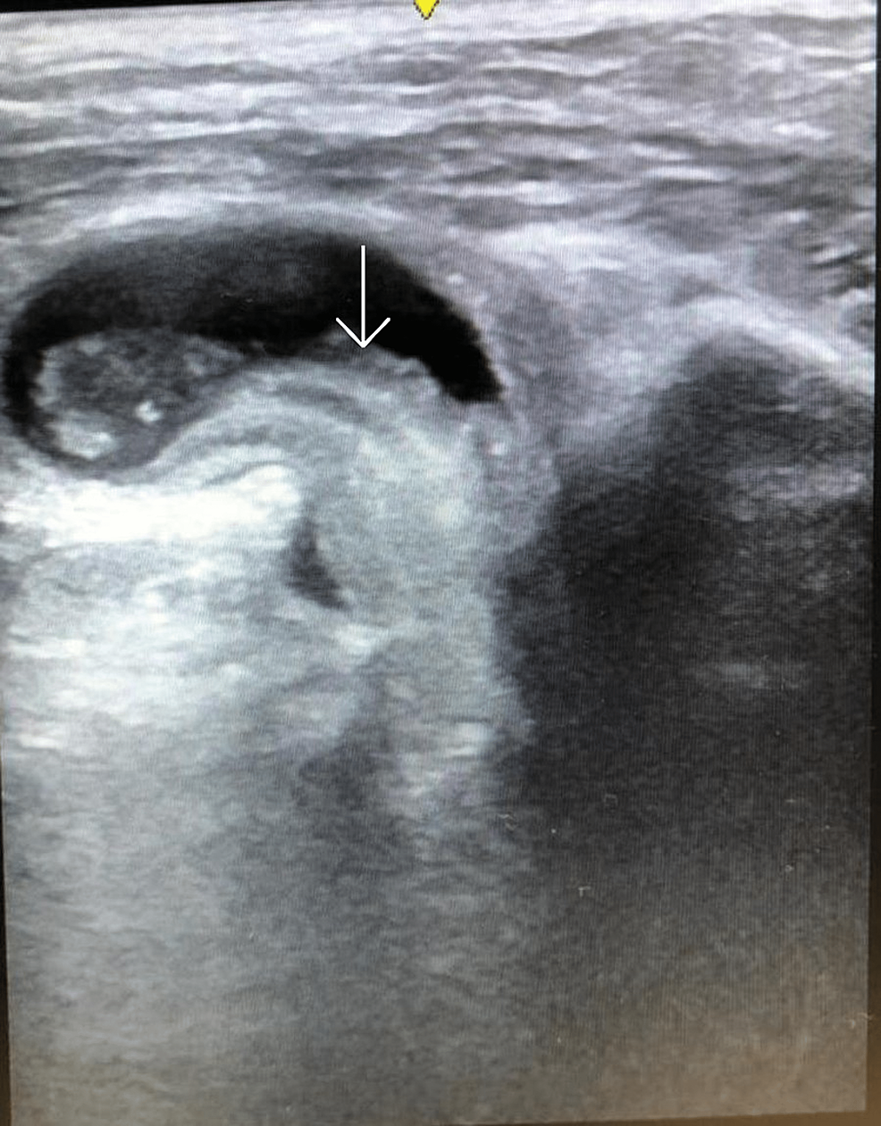 POCUS-scan-of-the-inguinal-region-(transverse-plane)-showing-the-obturator-hernia-with-incarcerated-loops-of-bowel-(white-arrow).