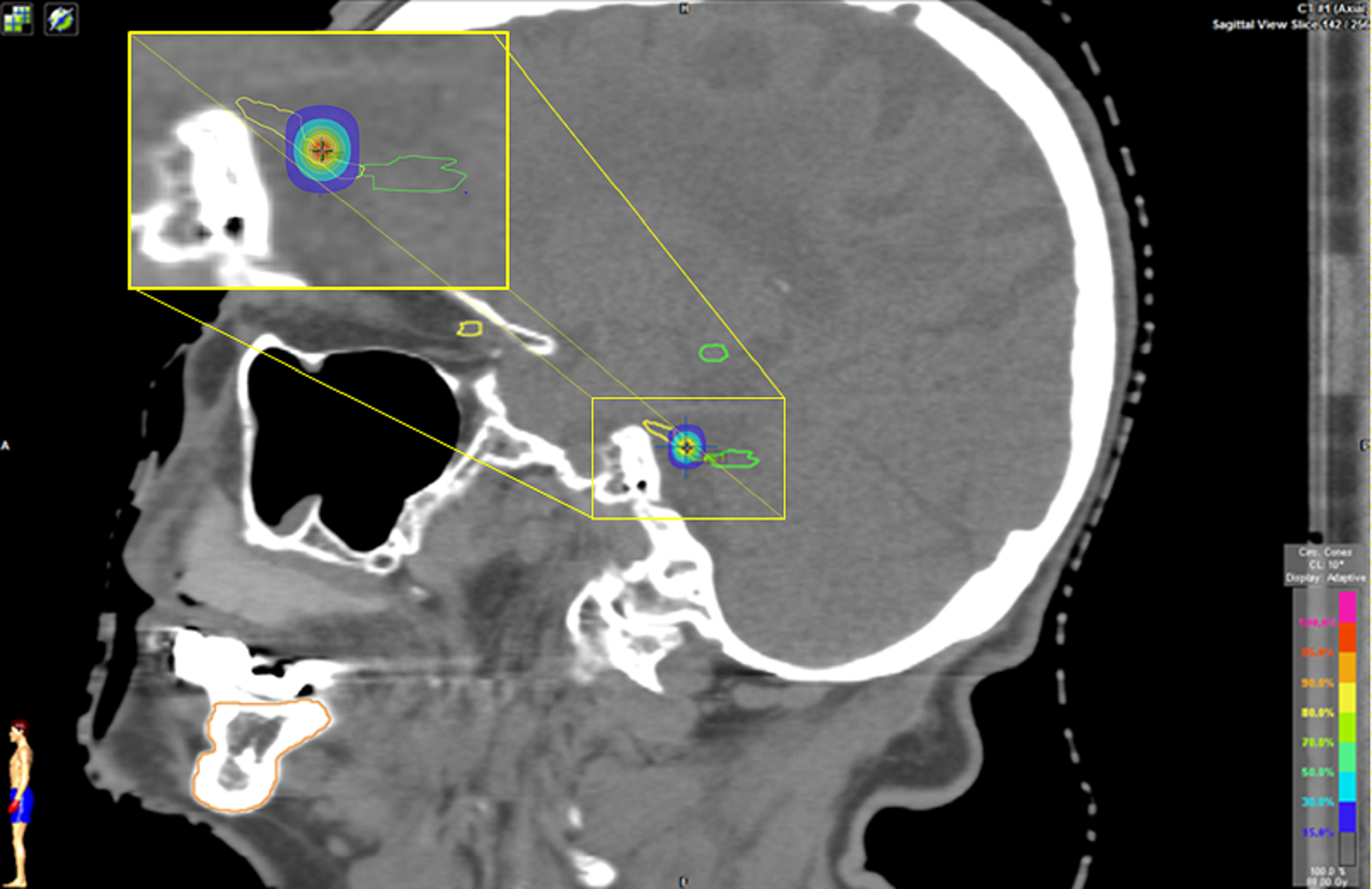 Cureus | Frameless Stereotactic Radiosurgery, A Feasible Alternative To ...