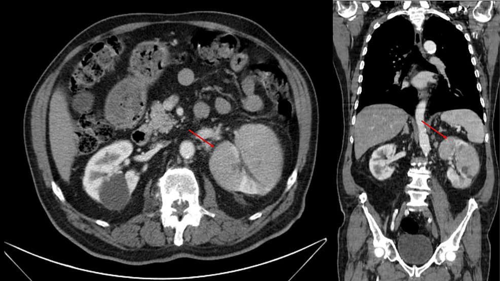 Cureus Systemic Bacillus Calmette Gu Rin Bcg Infection With Renal Involvement A Rare