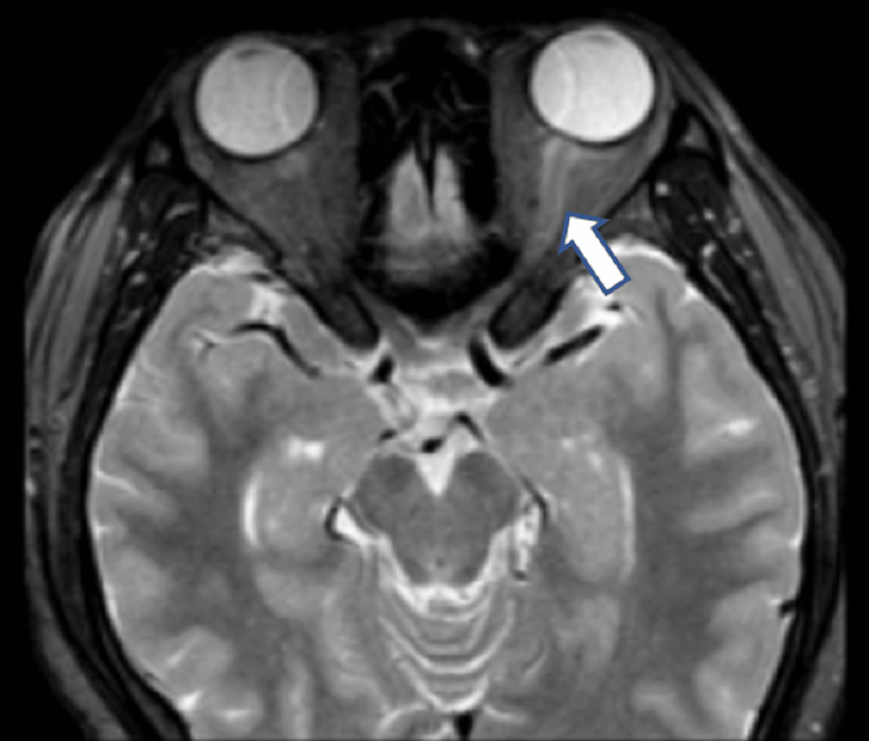 a-rare-complication-of-herpes-zoster-ophthalmicus-hzo-cureus