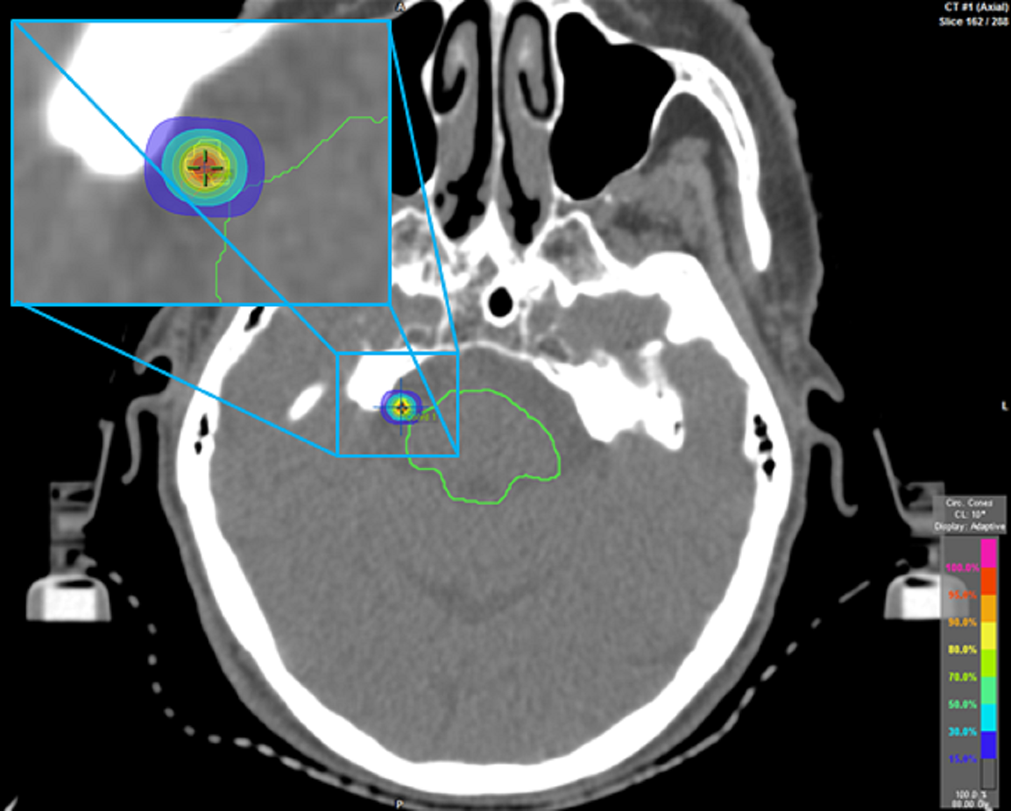 Cureus Frameless Stereotactic Radiosurgery A Feasible Alternative To The Frame Based 7193