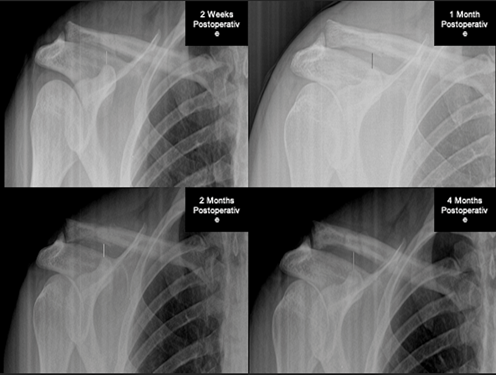 AP-radiographs-of-subject-3-with-two-weeks,-one-month,-two-months,-and-four-months-postoperative-radiographs-available.-At-the-subject’s-two-weeks-visit,-the-CC-distance-is-7.8mm.-During-the-one-month-visit,-the-CC-distance-is-8.0mm.-At-the-two-months-visit,-CC-distance-is-8.1mm.-At-the-four-months-visit,-the-CC-distance-slightly-increased-to-10.3mm.