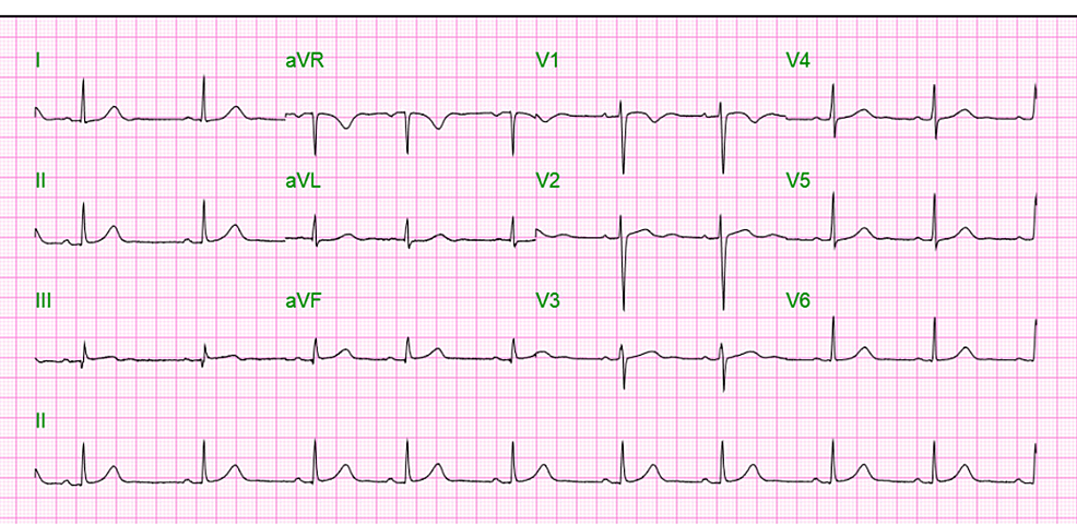 Electrocardiogram (EKG) - on display - showing - sinus rhythm
