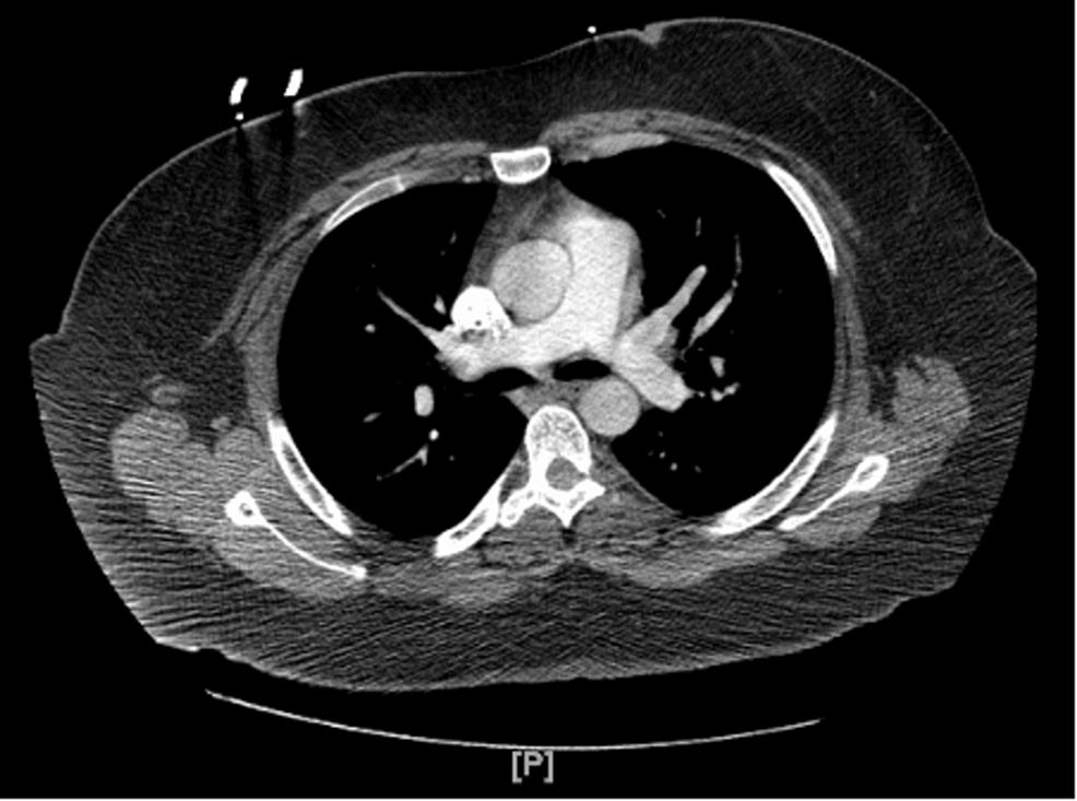 Computed tomography angiography (CTA) scan of the chest showed no evidence of pulmonary embolism