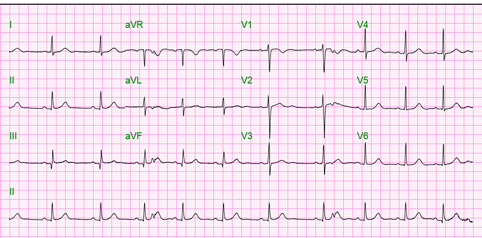Electrocardiogram (EKG) on day 4 shows normal sinus rhythm.