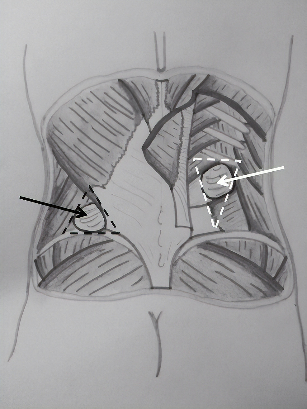 Cureus Management Criteria of Grynfeltt's Lumbar Hernia A Case