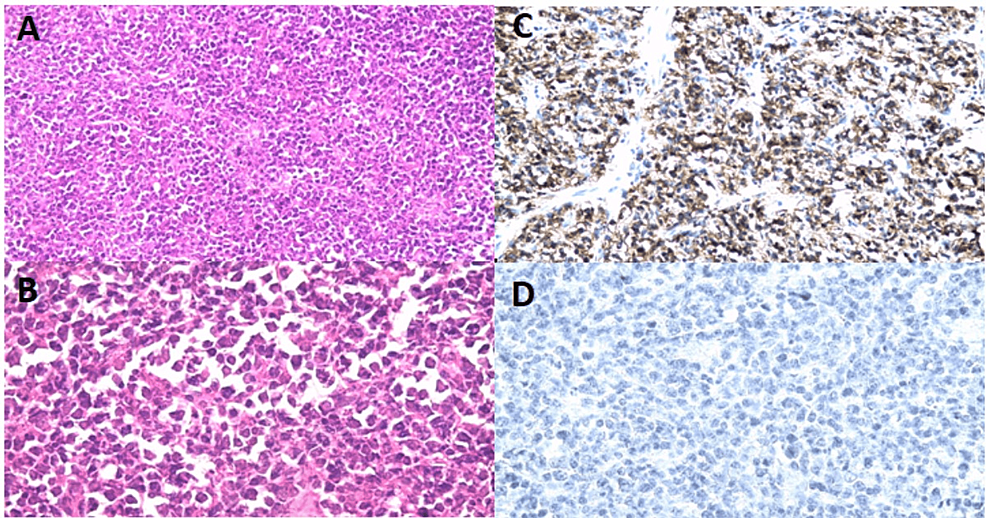 An Extranodal Site Of Diffuse Large B-cell Lymphoma Presenting As ...