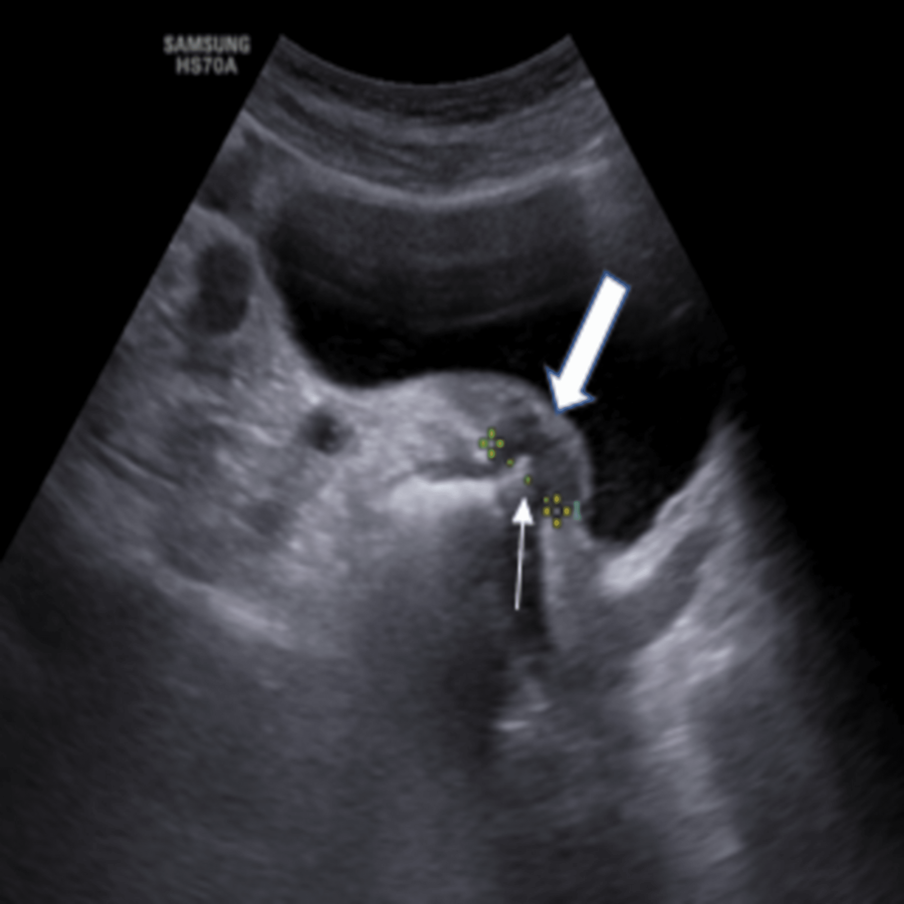 colo-vesical-fistula-relevance-of-conventional-radiology-in-the-modern