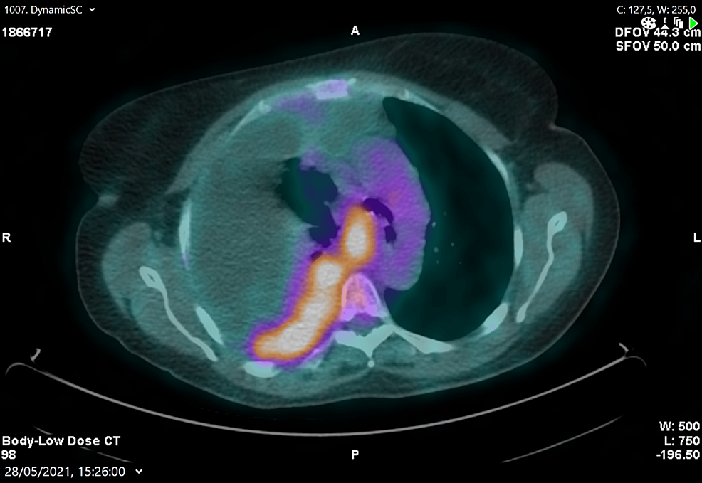 Positron emission tomography showing right-sided pleural involvement