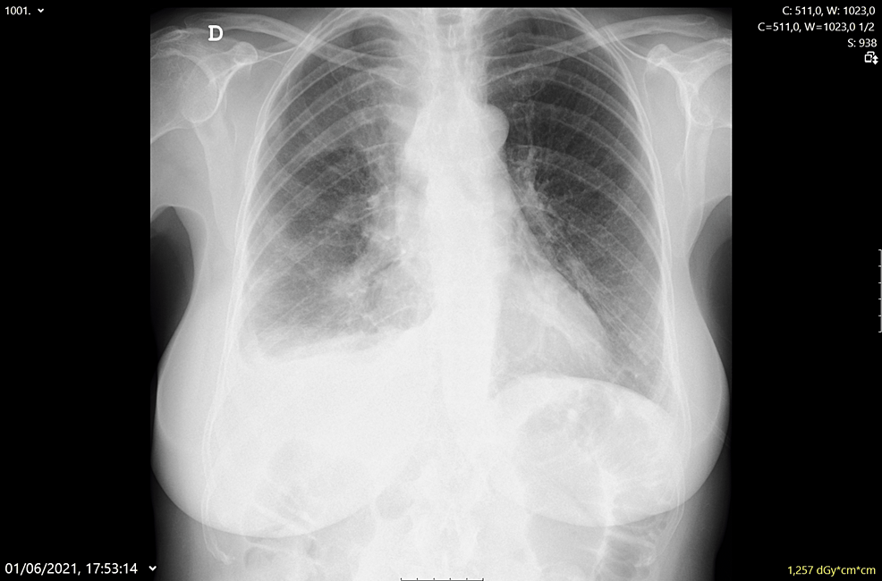 Chest X-ray after thoracentesis