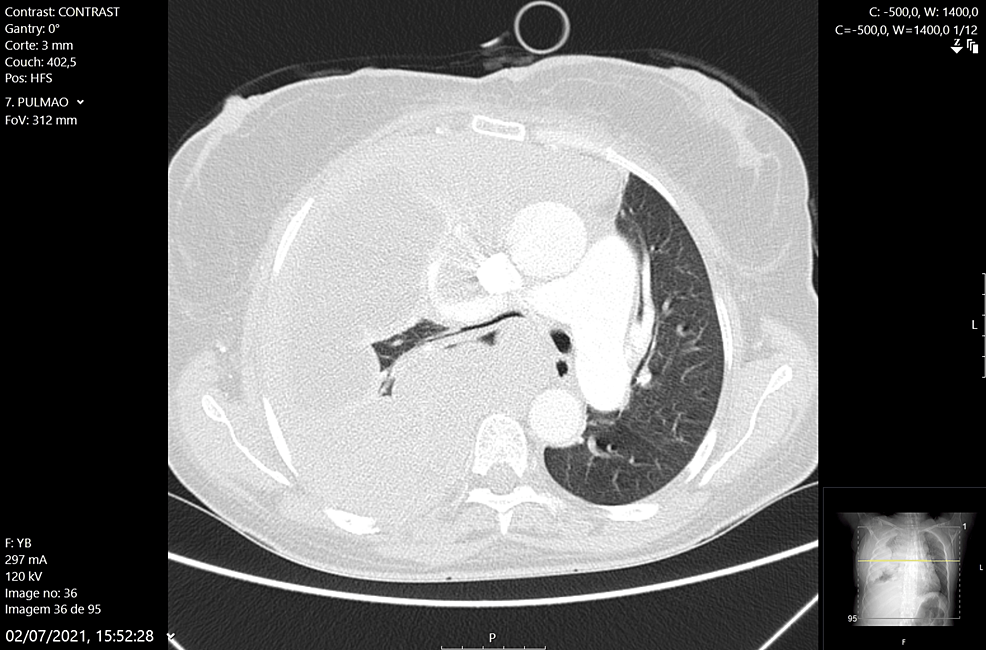 Chest CT scan showing near complete involvement on the right side