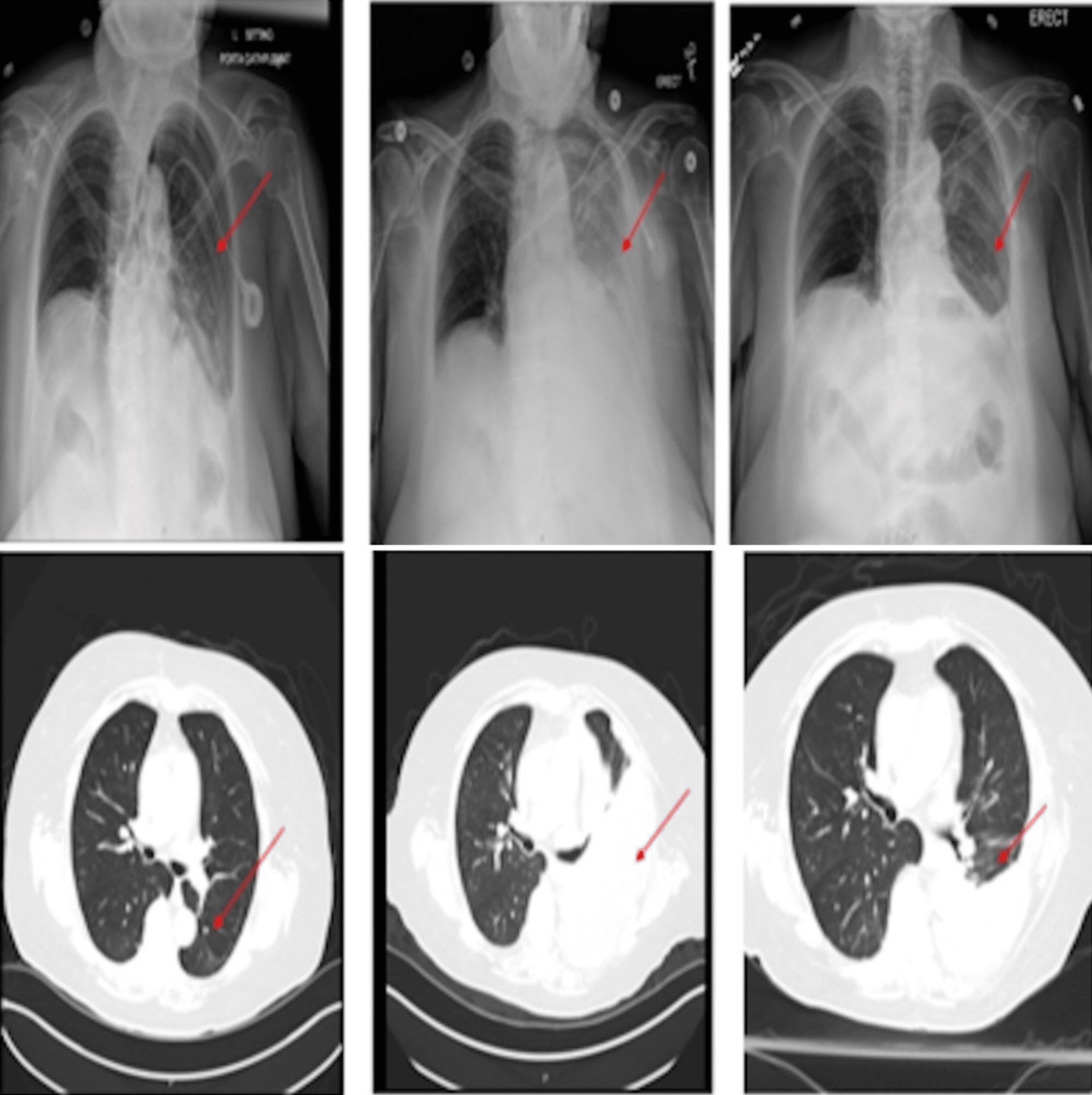 an-unusual-case-of-candida-albicans-empyema-in-patient-with-gastric