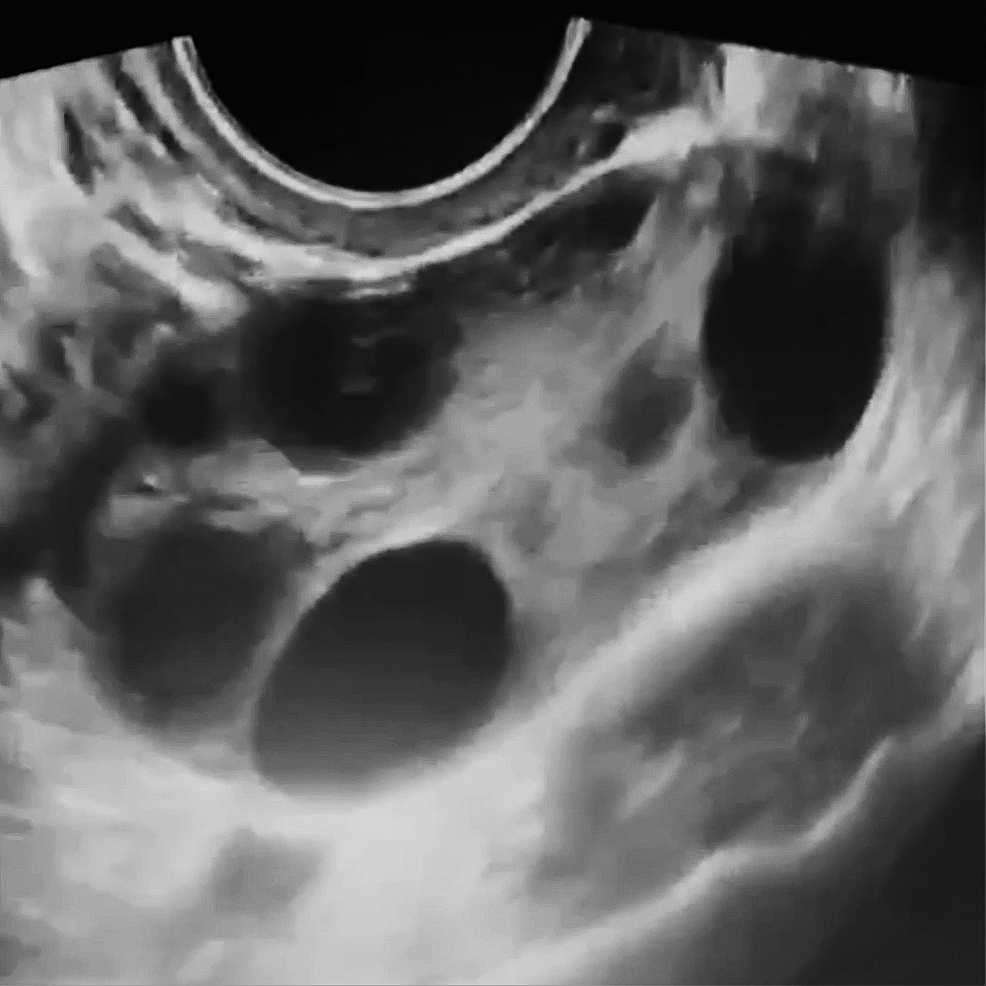 Cureus  Spontaneous Ovarian Hyperstimulation Syndrome Associated