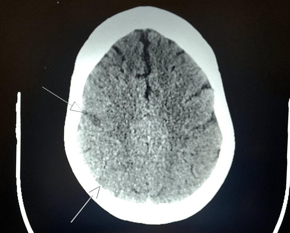 CT-brain-showing-acute-infarct-in-the-right-frontal-and-right-parietal-lobes.-