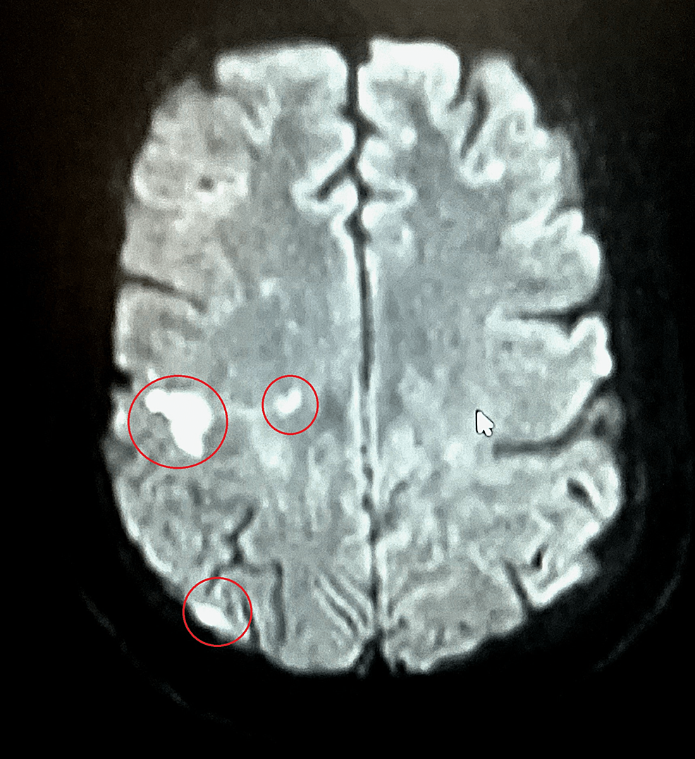 MRI-showing-scattered-multifocal-lesions-of-acute-and-subacute-infarctions.