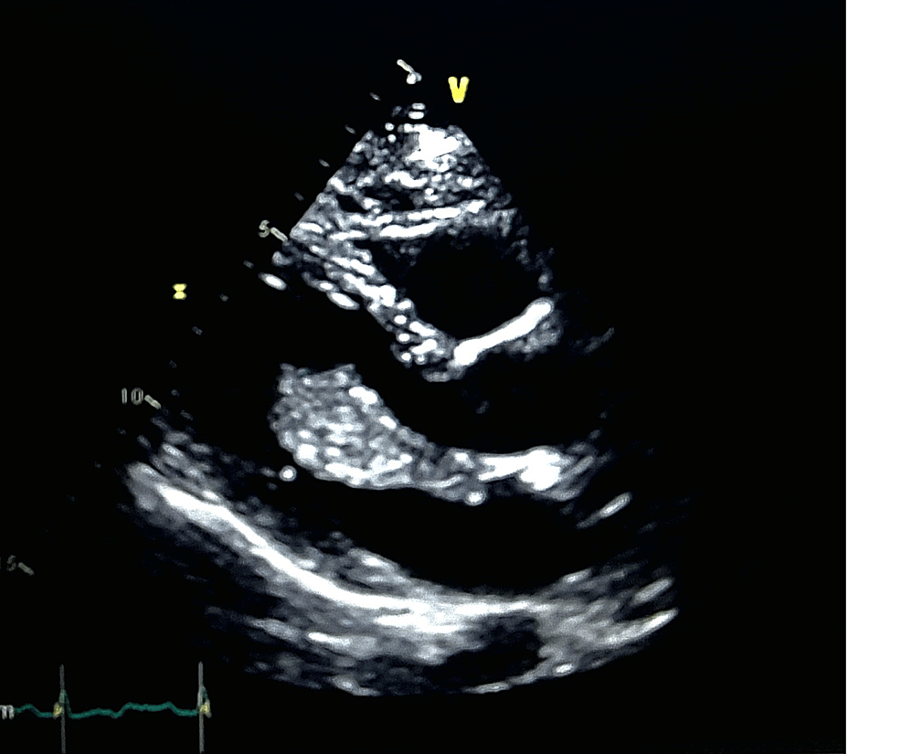 Echocardiogram-showing-a-myxoma-in-the-left-atrium.