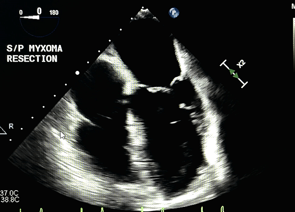 Echocardiogram-showing-a-four-chamber-view-post-resection-of-myxoma.