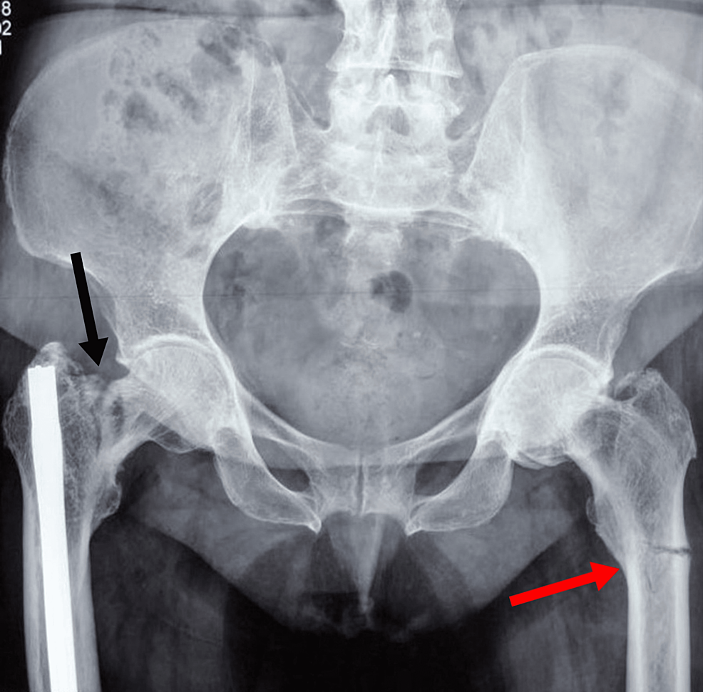 Cureus | Simultaneous Bilateral Insufficiency Femoral Fractures After ...