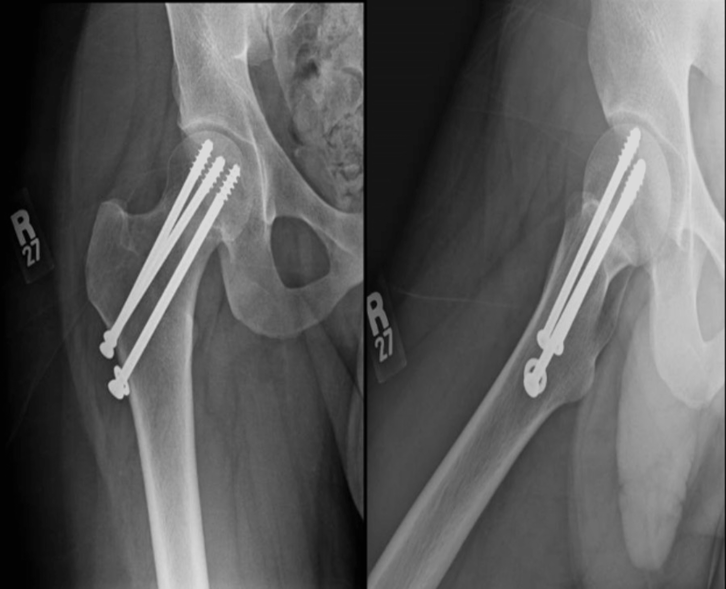 Completely Displaced Femoral Neck Stress Fracture in a Young Male