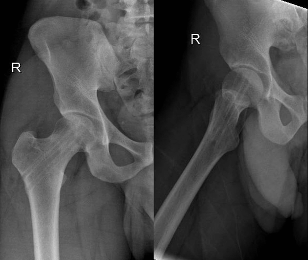 Cureus Completely Displaced Femoral Neck Stress Fracture In A Young Male Soldier With Almost 8734