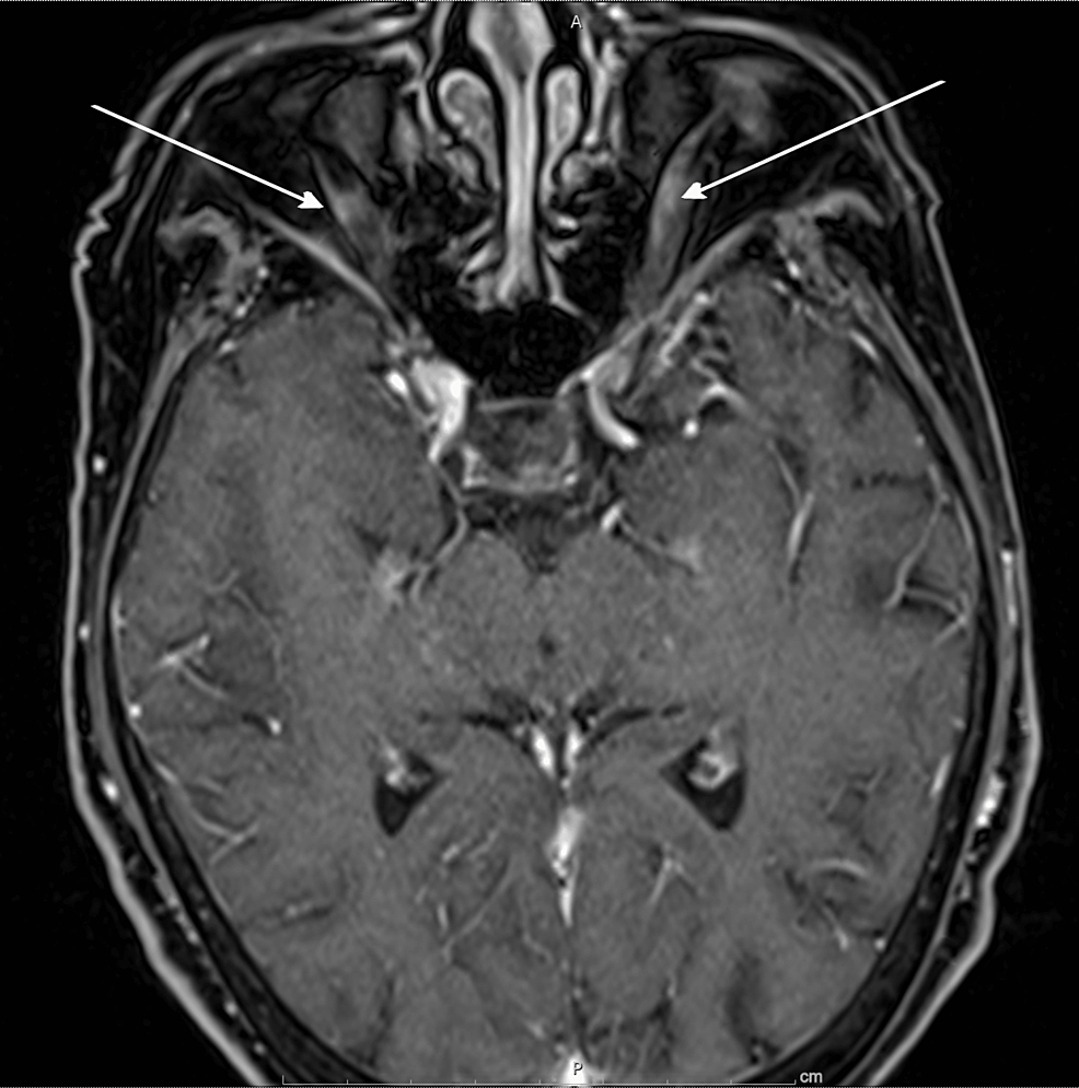 Cureus | Leptomeningeal Carcinomatosis: A Rare Complication of ...