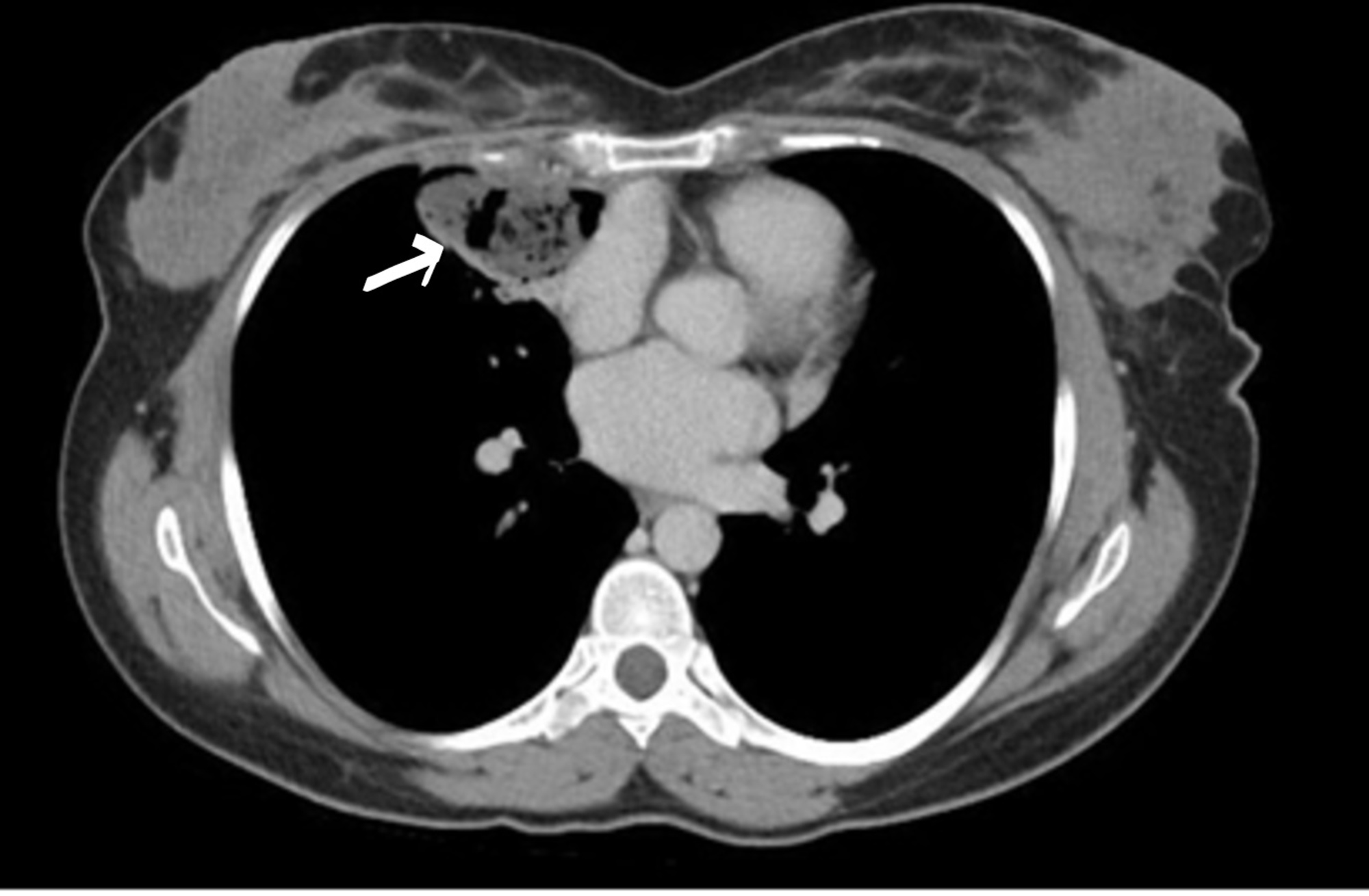 Cureus A Case Report Of Intrapulmonary Teratoma In The Right Upper