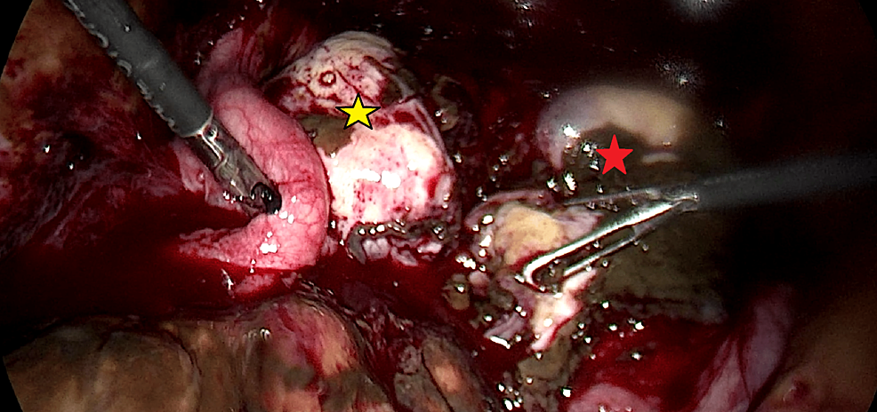 ovarian cyst popping