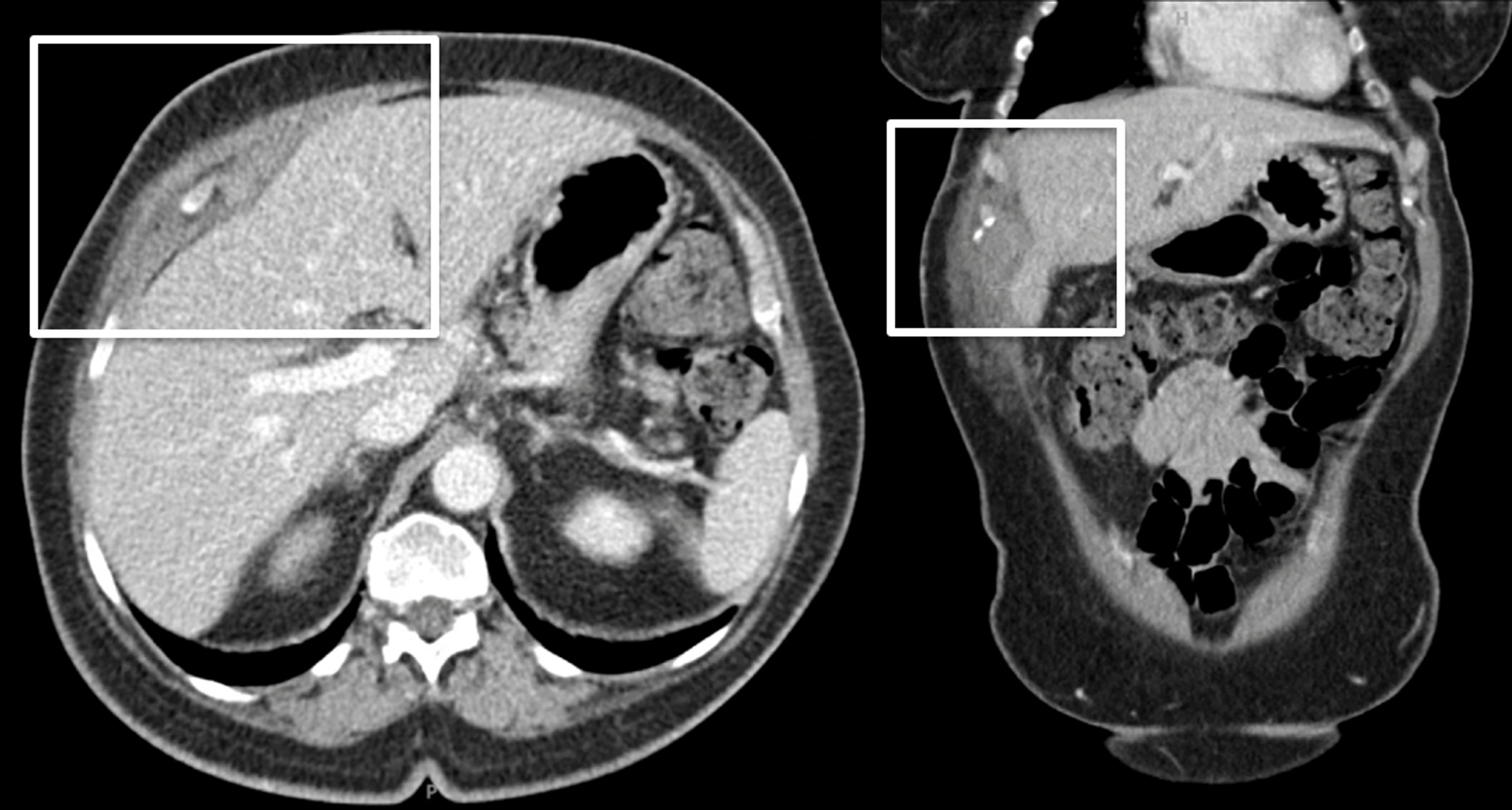 Delayed Postcholecystectomy Gallbladder Fossa Abscess Due to