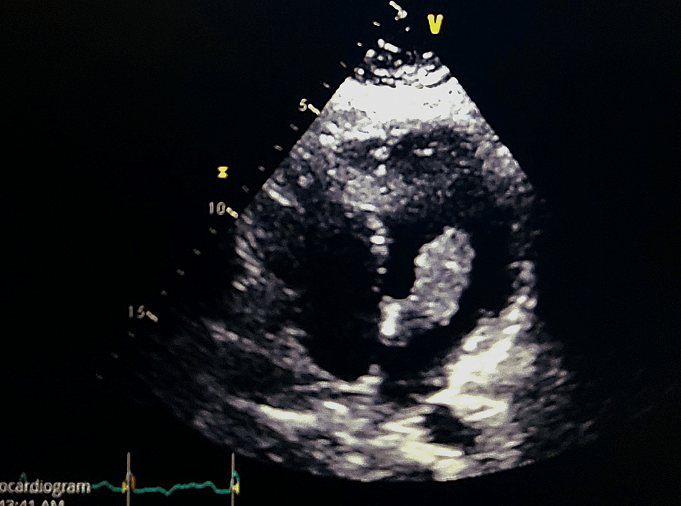 Another-view-of-myxoma-in-the-left-atrium.