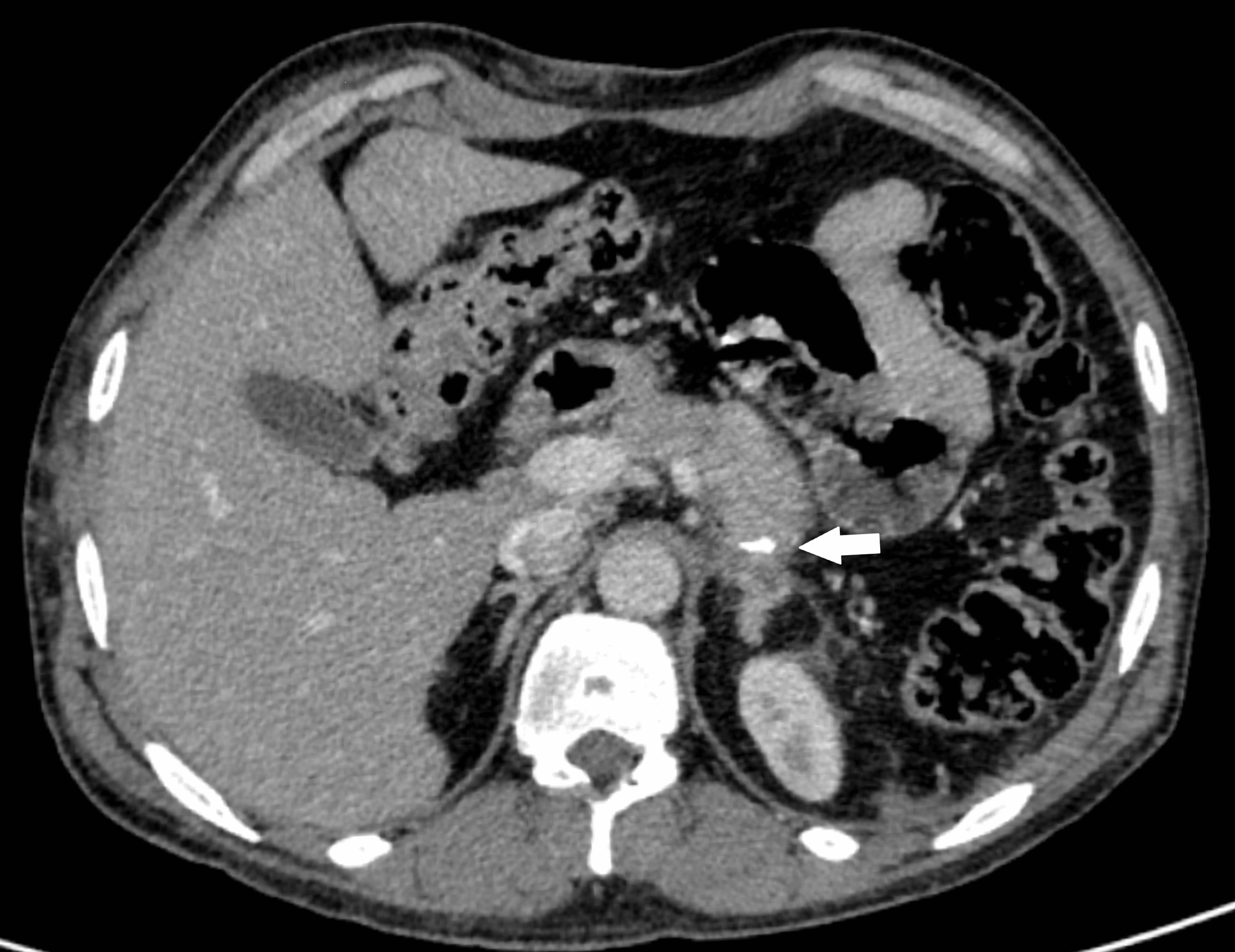 Insulinoma Mimicking Psychiatric Illness: A Covert Endocrine Tumor | Cureus