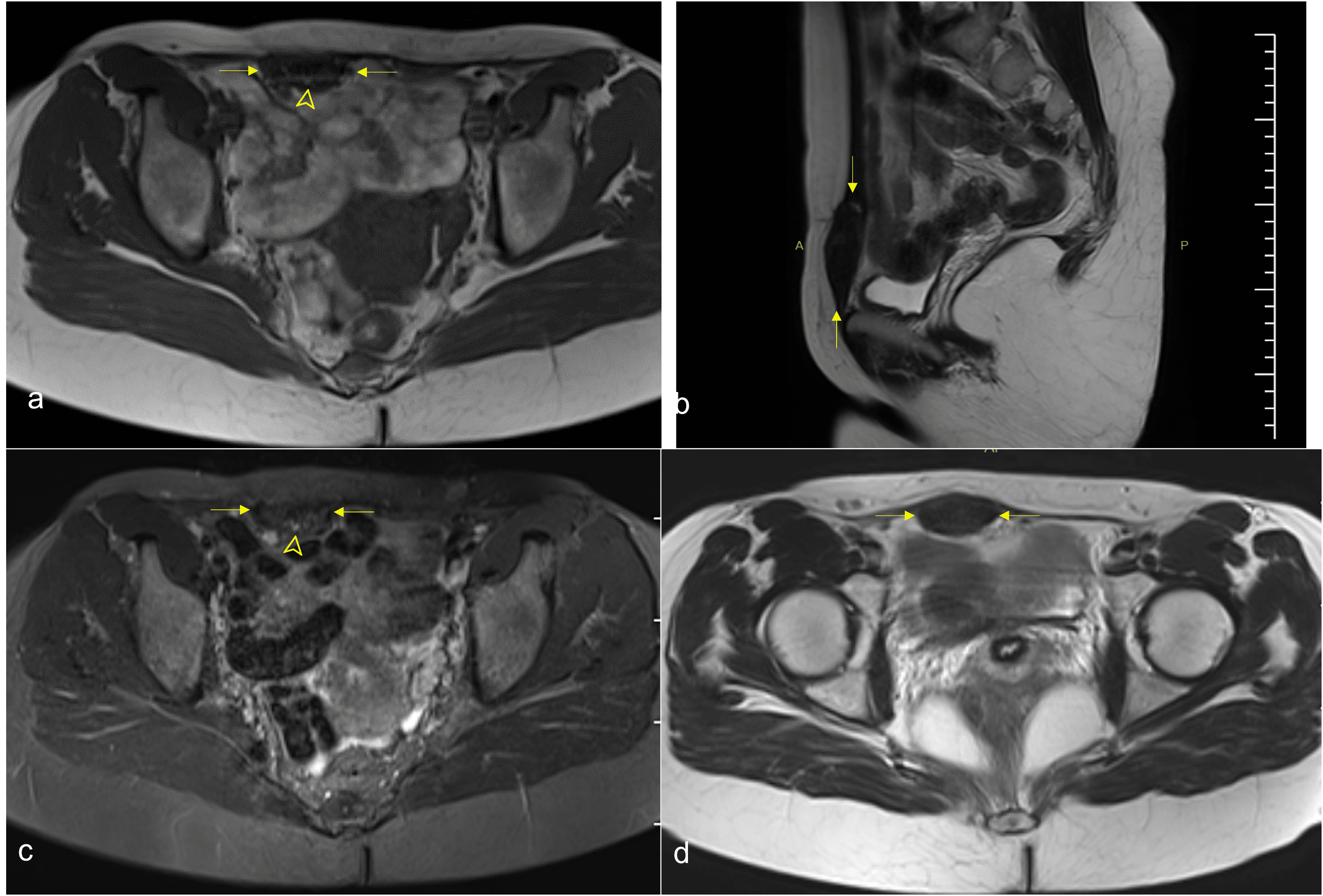 Cureus | A Rare Occurrence Of Endometriosis Externa Individually Within ...