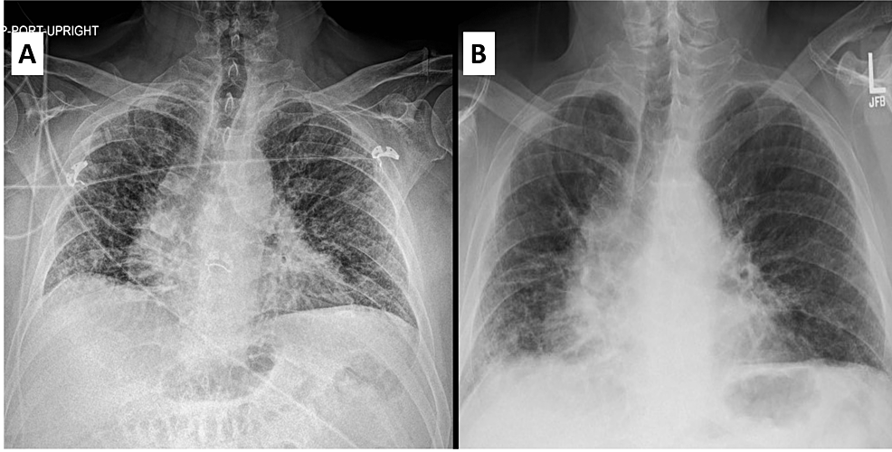 Cureus | Infliximab-Induced Non-specific Interstitial Pneumonitis in a ...