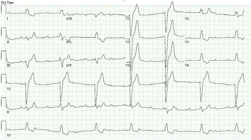 An Interesting Case of Atherosclerotic Occlusion of the First Septal ...