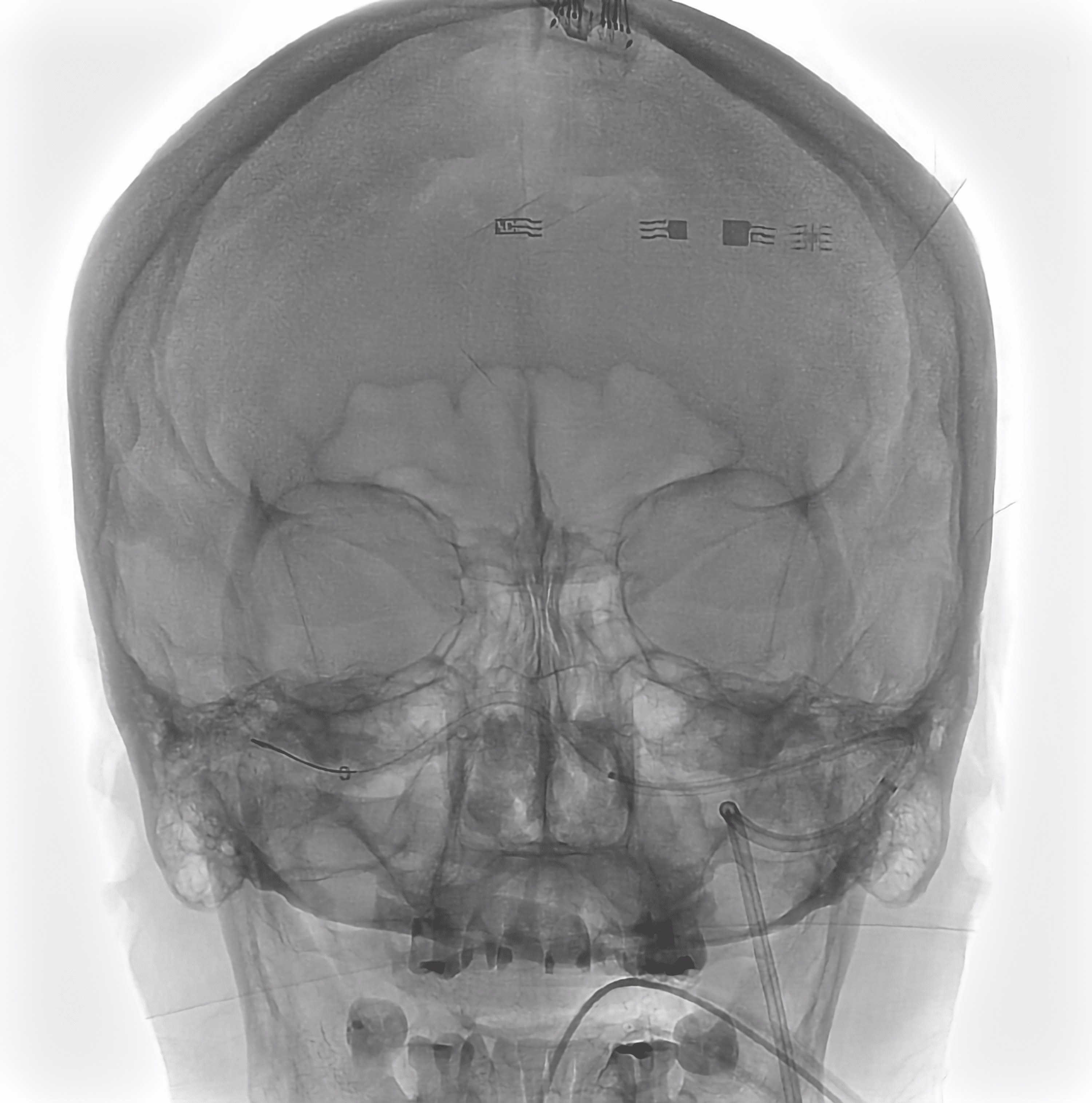 Cureus | Coronary Stent for Right Transverse Venous Sinus Stenosis in a ...