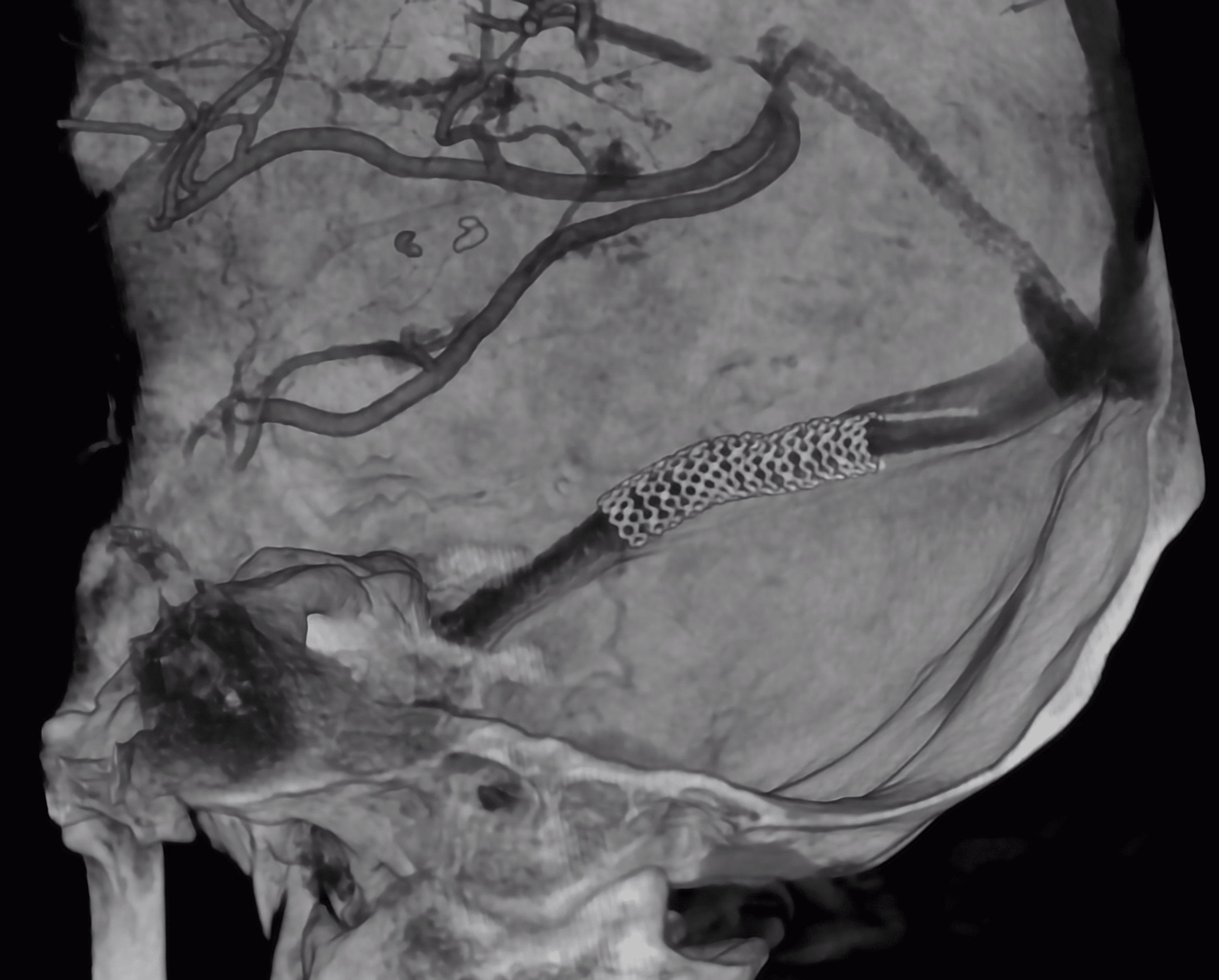 Cureus | Coronary Stent for Right Transverse Venous Sinus Stenosis in a ...