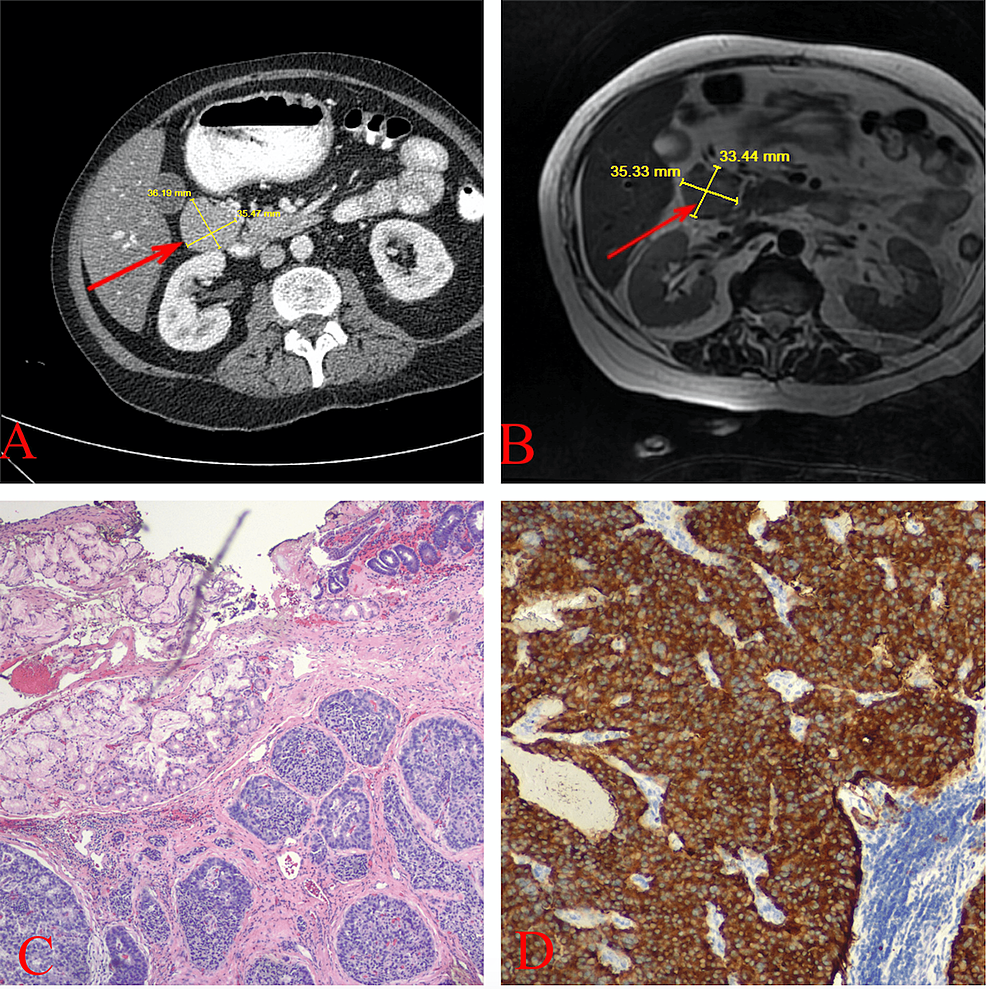 Where Does Duodenal Cancer Spread To